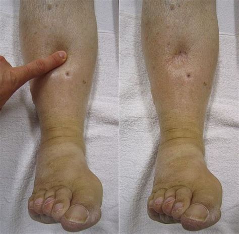 001 of right lower extremity; I87. . Icd 10 bilateral lower extremity edema